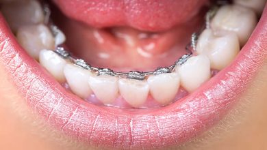 Lingual Braces What Are They Used For