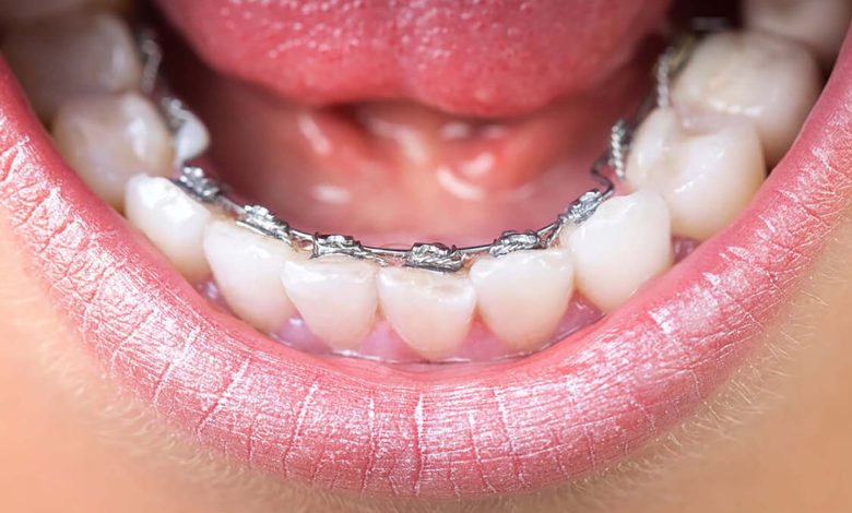 Lingual Braces What Are They Used For