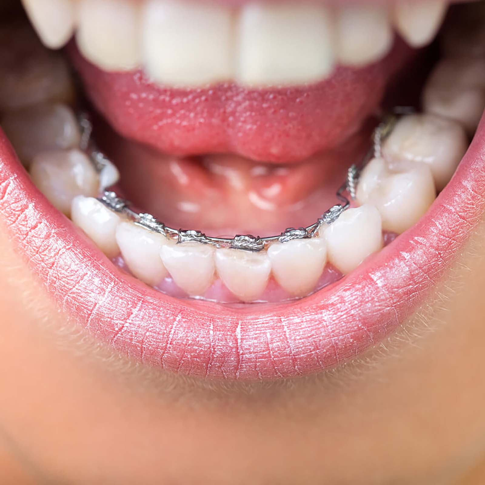 Lingual Braces What Are They Used For