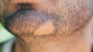 Balding Treatments for Beard Regrowth