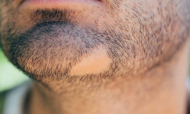 Balding Treatments for Beard Regrowth