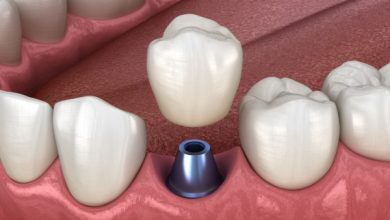 Dental Implants after Oral Cancer Treatment