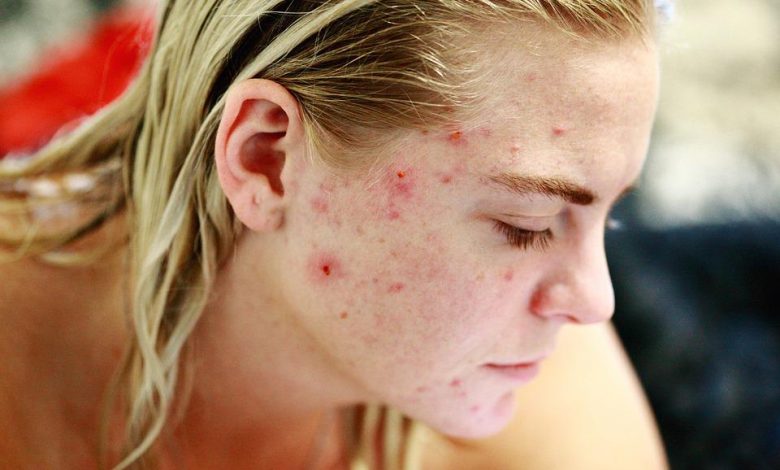 acne scars